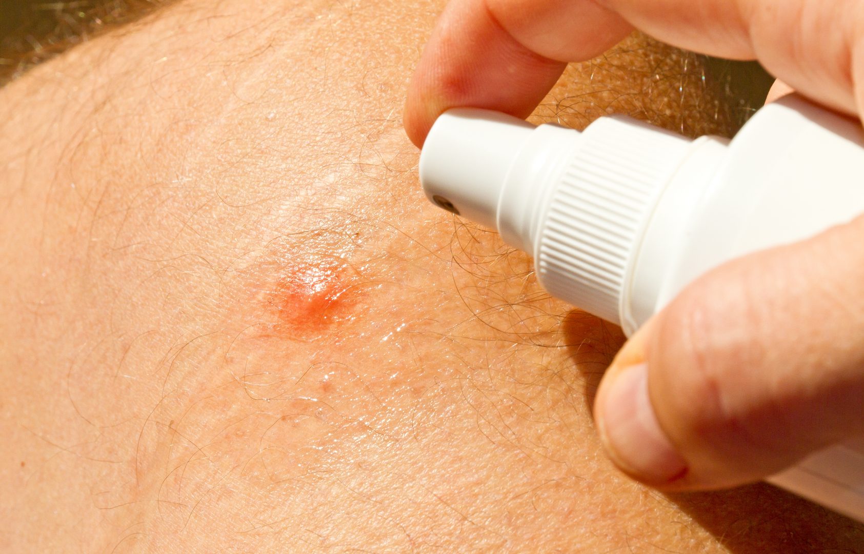 Mosquito Bite Spraying